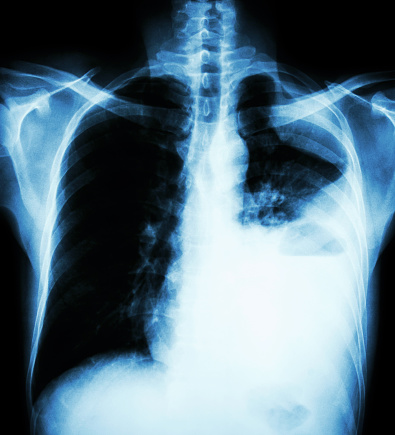Tumore polmonare metastatico, immunoterapia dopo terapia standard può migliorare la sopravvivenza 